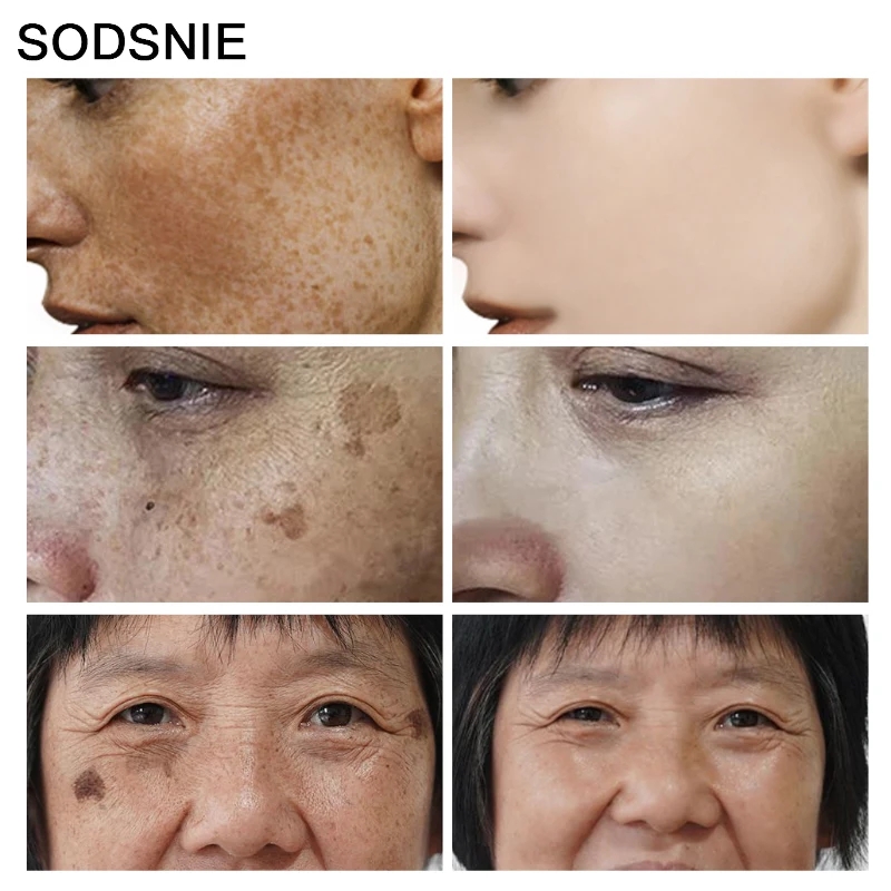 Eliminador de manchas oscuras, - Skincare Niacinamide reseña y precio